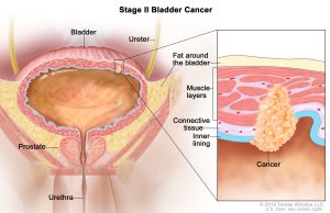 What is Bladder Cancer? Bladder Cancer