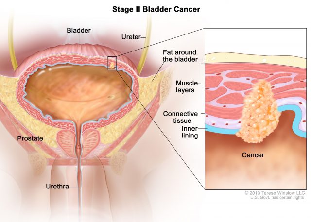 Bladder Cancer