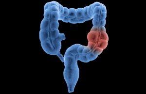 What is Colorectal Cancer? Colateral Cancer