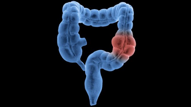 Colateral Cancer