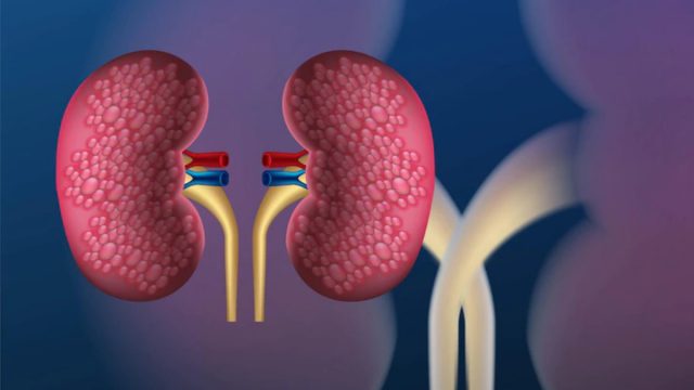 Kidney Cancer