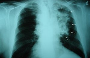 What is Lung Cancer? Lung Cancer