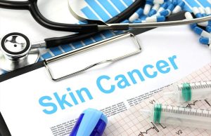 What is Skin Cancer? Skin Cancer