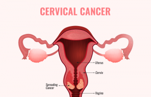 What is Cervical Cancer? What is Cervical Cancer?