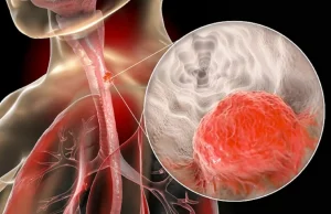 What is Esophageal Cancer? What is Esophageal Cancer?