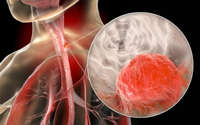 What is Esophageal Cancer?