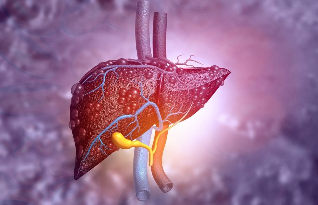 What is Liver Cancer?