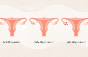 What is Ovarian Cancer? What is Ovarian Cancer?