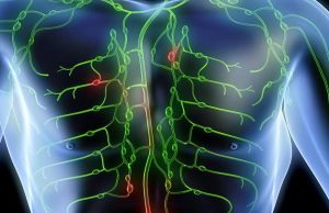 What is Lymphoma? lymphoma