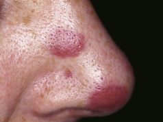 What is Sarcoma? What is Sarcoma?
