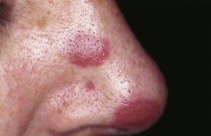 What is Sarcoma? What is Sarcoma?