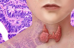 What is Thyroid Cancer? What is Thyroid Cancer?