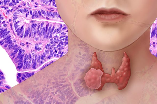 What is Thyroid Cancer?