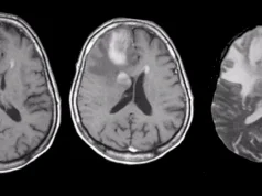 Confronting Primary CNS Lymphoma: Your Guide to Diagnosis & Treatment Options Primary CNS Lymphoma Treatment