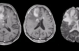 Confronting Primary CNS Lymphoma: Your Guide to Diagnosis & Treatment Options Primary CNS Lymphoma Treatment
