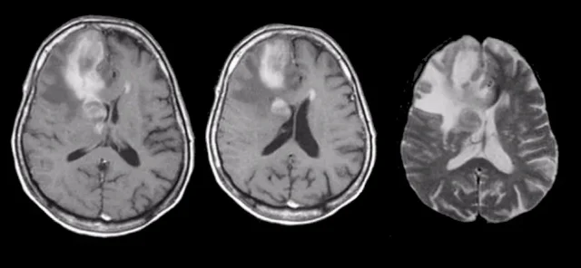 Primary CNS Lymphoma Treatment