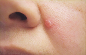 Basal Cell Carcinoma Of The Skin – See Skin Cancer