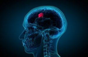 Astrocytomas, Childhood (brain Cancer)