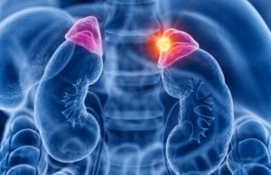 Adrenocortical Carcinoma: A Rare and Aggressive Cancer