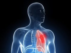 Lung Cancer By Age Non Smoker