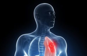 Lung Cancer By Age Non Smoker