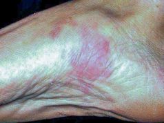 Kaposi Sarcoma: Understanding This Rare and Complex Cancer Kaposi Sarcoma