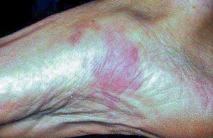 Kaposi Sarcoma: Understanding This Rare and Complex Cancer Kaposi Sarcoma