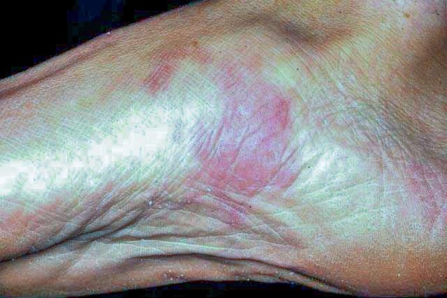 Kaposi Sarcoma