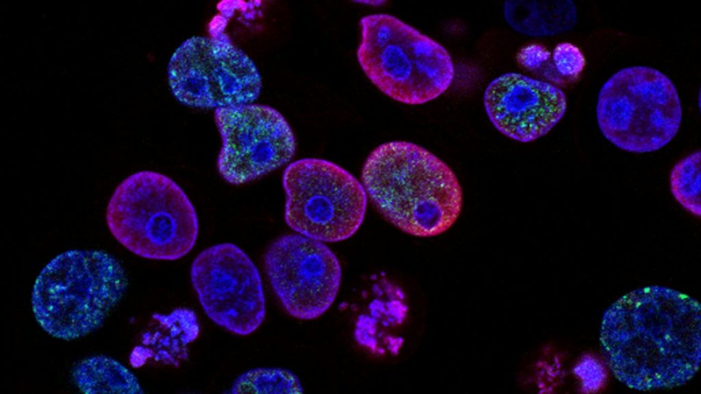 Colorectal Carcinoma: Microsatellite Instability (MSI-High), Mismatch Repair Deficiency & Nivolumab - Featured Image